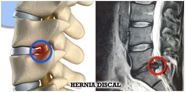 hernia-discal